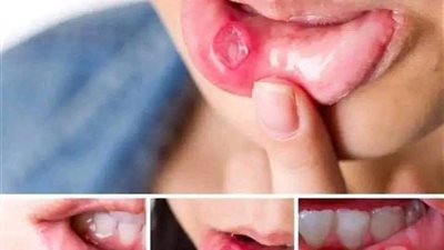 علاج قرح الفم في المنزل بـ4 خطوات بسيطة.. تخلص منها سريعا 