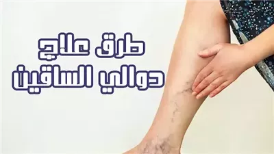 كنز جعله الله علاج لدوالي الساقين .. موجود في كل منزل ويشفي بسرعة