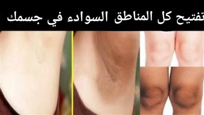 وداعاً لمناطق سوداء في الجسم .. علاج نهائي و بسيط لأسوداد الجلد 